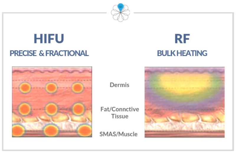 Khám phá điểm khác biệt giữa công nghệ Hifu và Thermage.